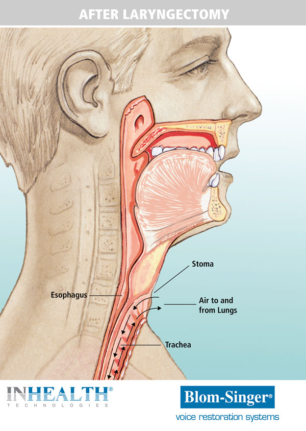 Anatomy after a larynctomy