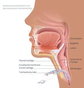 Inhalation and exhalation with tracheostomy