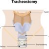 what is tracheostomy